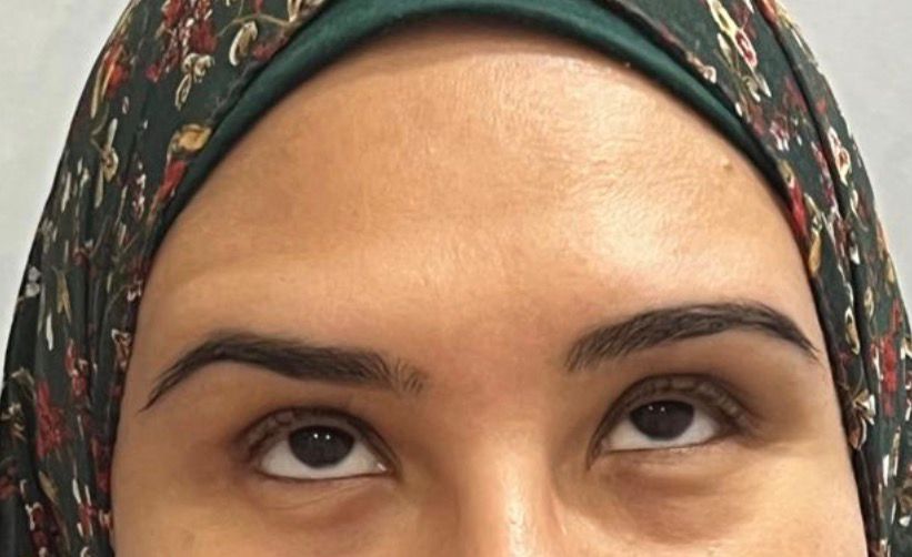 Botox After 2