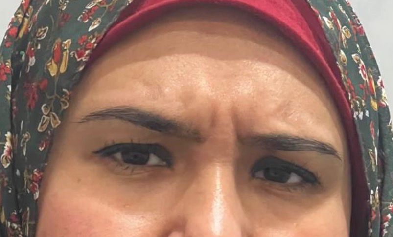 Botox Before 3